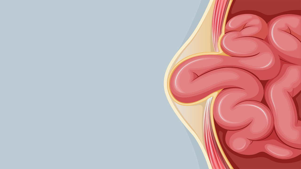 Fistula Treatment in Delhi | Dr. Neeraj Chaudhary