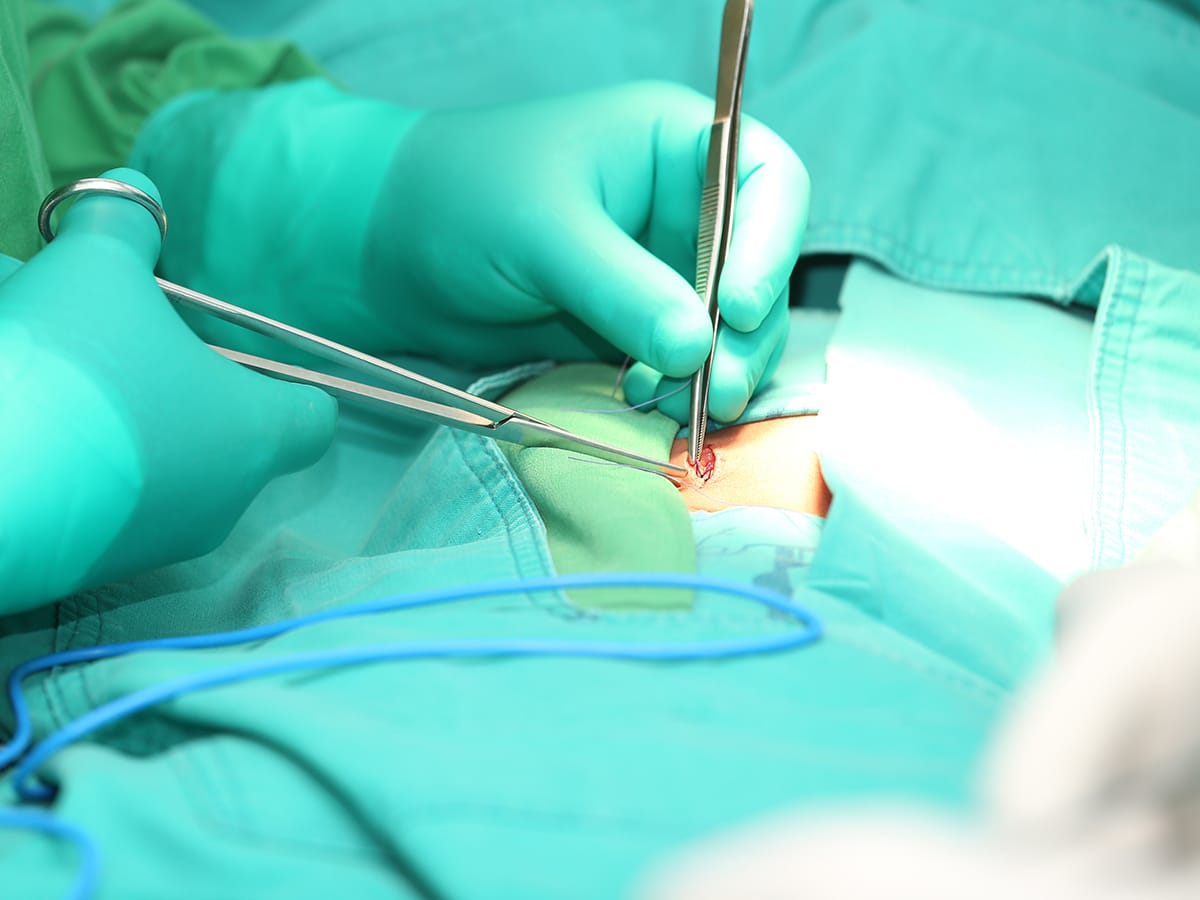 Hernia Treatment in Delhi | Dr. Neeraj Chaudhary