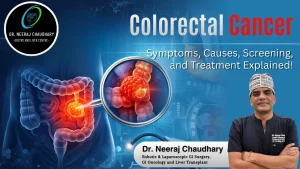 Colorectal Cancer Symptoms, Causes, Screening, and Treatment Explained