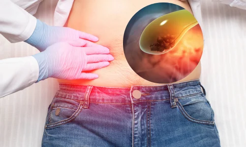 Gallstones