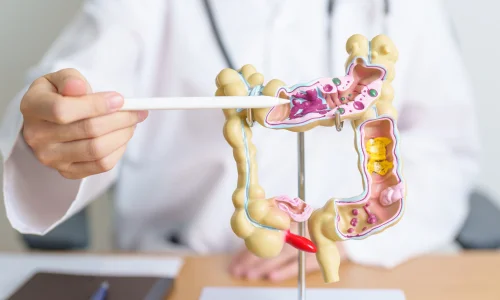 Inflammatory Bowel Disease